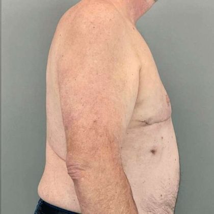 Gynecomastia Before & After Patient #571