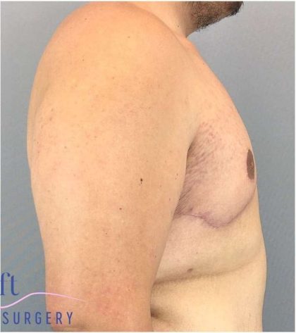 Gynecomastia Before & After Patient #582