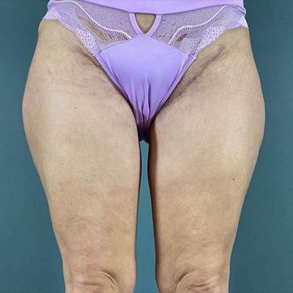 Thigh Lift Before & After Patient #233
