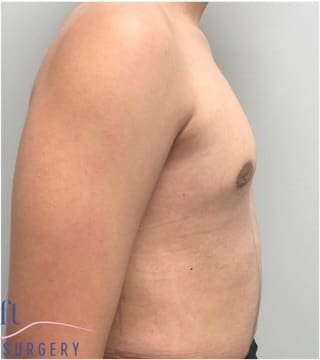 Gynecomastia Before & After Patient #593