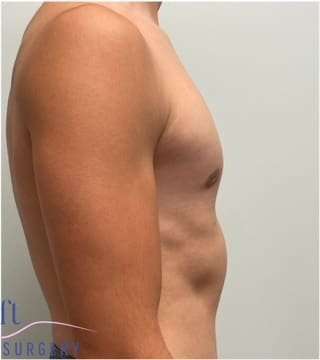 Gynecomastia Before & After Patient #604