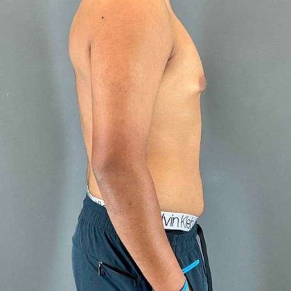 Gynecomastia Before & After Patient #622