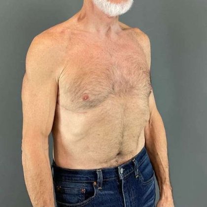 Gynecomastia Before & After Patient #642