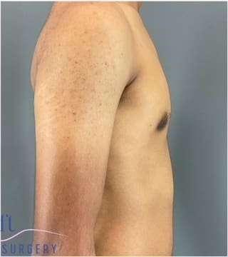 Gynecomastia Before & After Patient #653