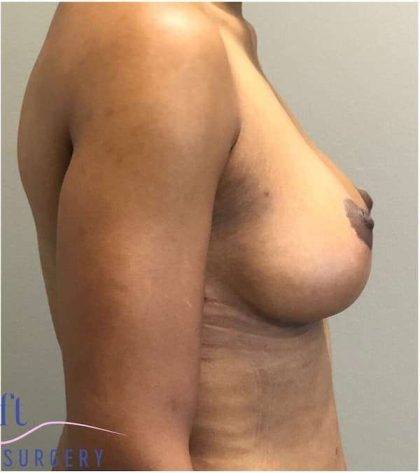 Breast Reduction Before & After Patient #686