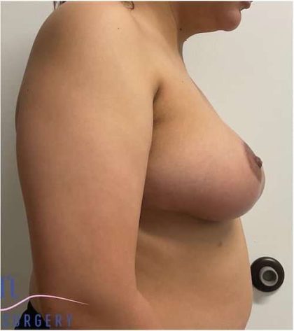 Breast Reduction Before & After Patient #697