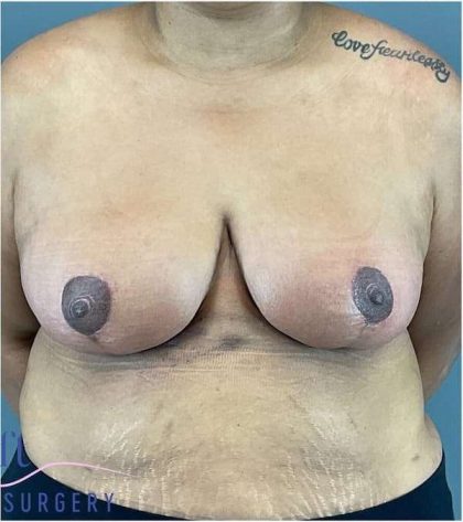 Breast Reduction Before & After Patient #708