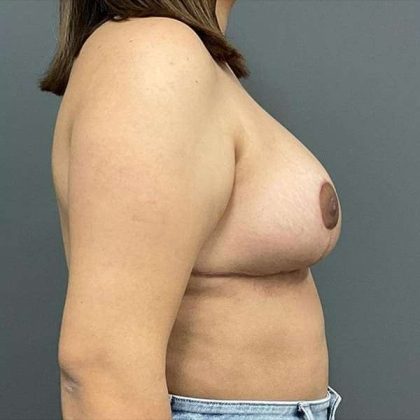 Breast Reduction Before & After Patient #719