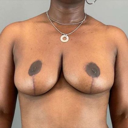 Breast Reduction Before & After Patient #730