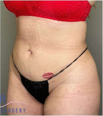 Liposuction Before & After Patient #166