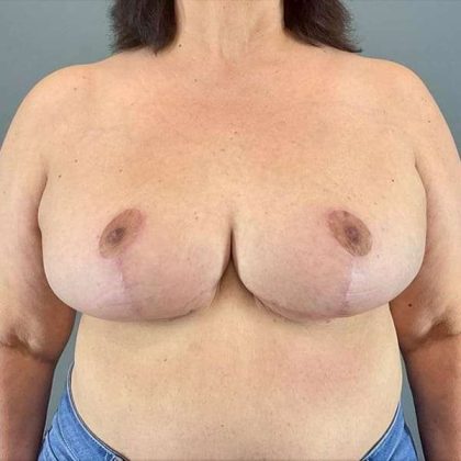 Breast Reduction Before & After Patient #763
