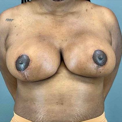 Breast Reduction Before & After Patient #774