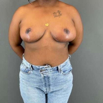 Breast Reduction Before & After Patient #828