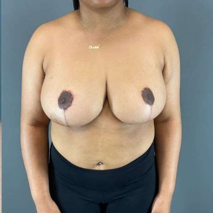 Breast Reduction Before & After Patient #850
