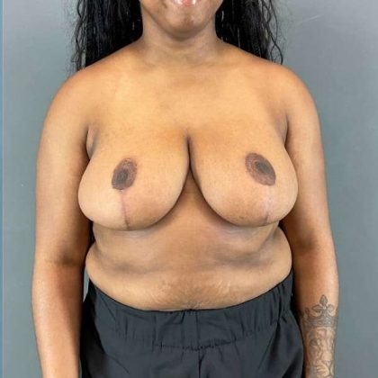 Breast Reduction Before & After Patient #861