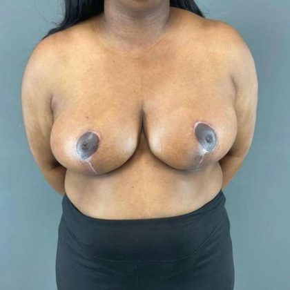 Breast Reduction Before & After Patient #883