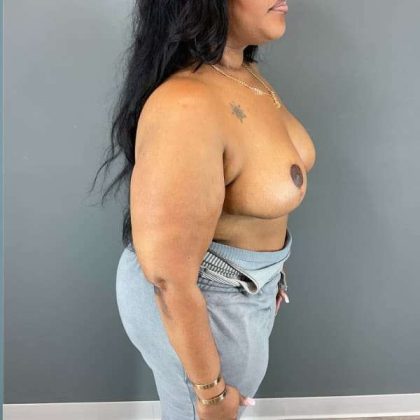 Breast Reduction Before & After Patient #927