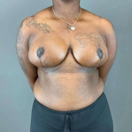 Breast Reduction Before & After Patient #938
