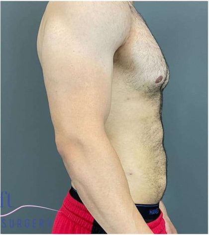 Bodytite Before & After Patient #280