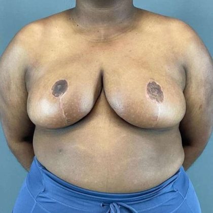 Breast Reduction Before & After Patient #978