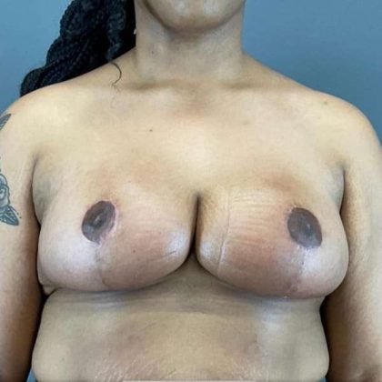 Breast Reduction Before & After Patient #998