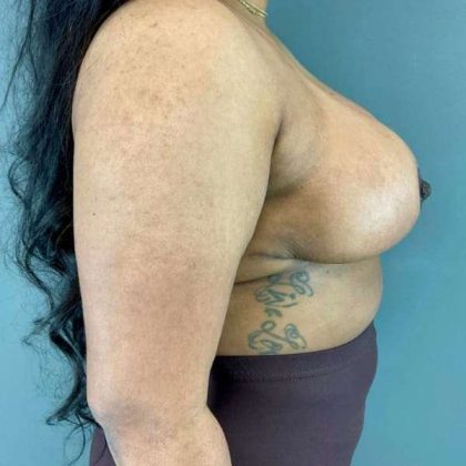 Breast Reduction Before & After Patient #1018