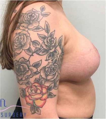 Breast Reduction Before & After Patient #1029