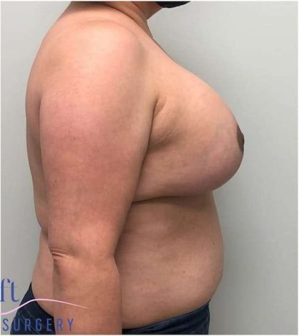 Breast Lift Before & After Patient #1040