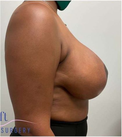 Breast Lift Before & After Patient #1051