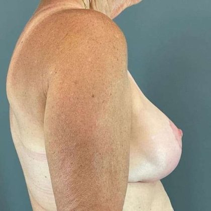 Breast Lift Before & After Patient #1062