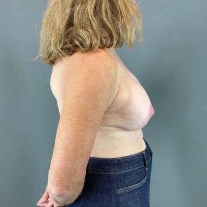 Breast Lift Before & After Patient #1073