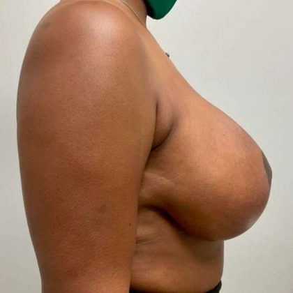 Breast Lift Before & After Patient #1084