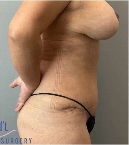 Tummy Tuck Before & After Patient #303