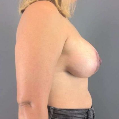 Breast Lift Before & After Patient #1109
