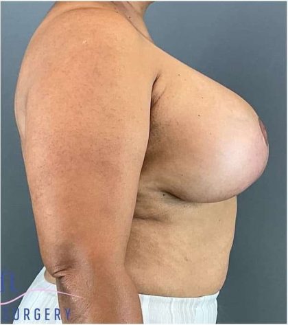 Breast Lift Before & After Patient #1131