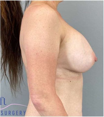 Breast Implant Exchange Before & After Patient #1142