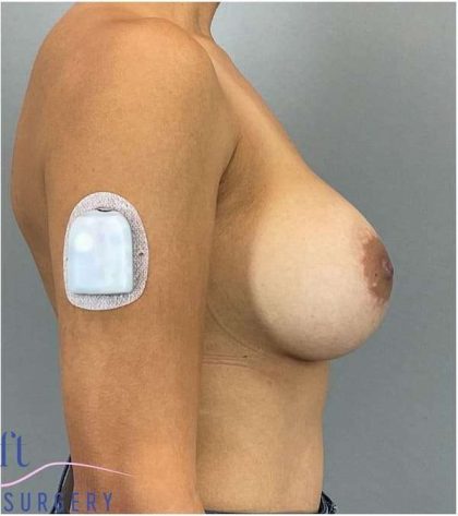 Breast Implant Exchange Before & After Patient #1164