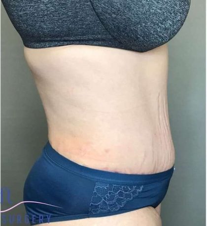 Tummy Tuck Before & After Patient #314