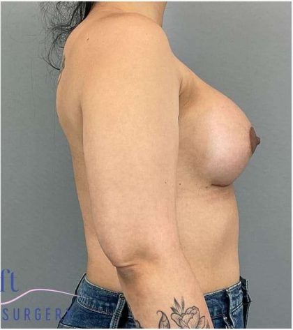 Breast Augmentation Before & After Patient #1219