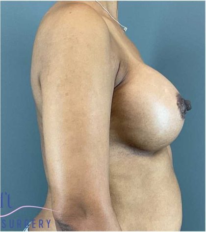 Breast Augmentation Before & After Patient #1296