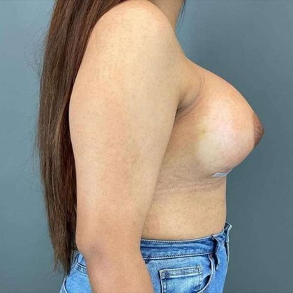 Breast Augmentation Before & After Patient #1318