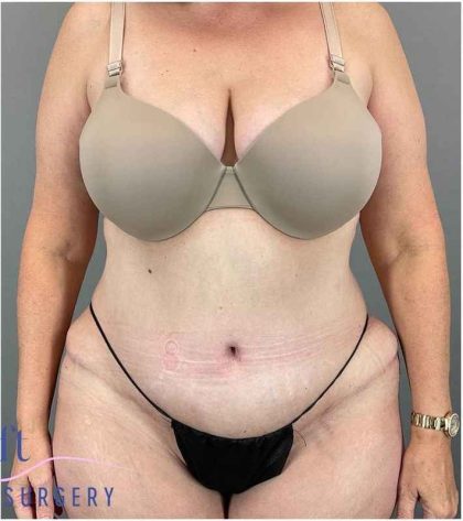 Tummy Tuck Before & After Patient #325