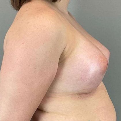 Breast Augmentation Before & After Patient #1362