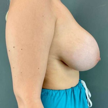 Breast Augmentation Before & After Patient #1384