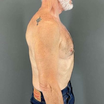 Gynecomastia Before & After Patient #642