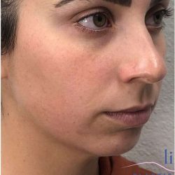 Injectables&Fillers Before & After Patient #125