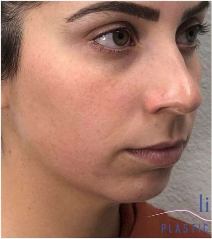 Injectables&Fillers Before & After Patient #125