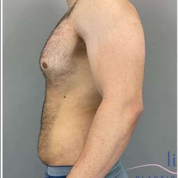 Liposuction Before & After Patient #188