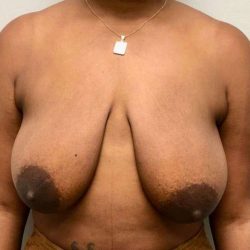 Breast Lift Before & After Patient #1084