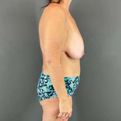 Breast Lift Before & After Patient #1091